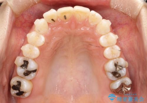 前歯のガタガタをインビザラインで矯正の治療中