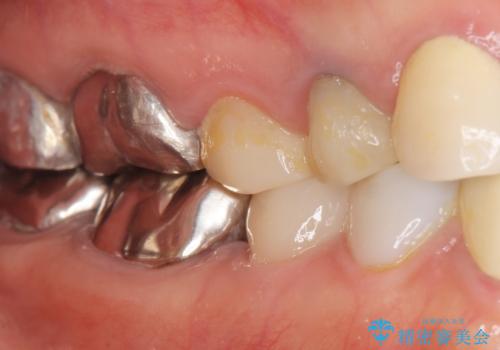 被せ物を入れたばかりの歯が痛む 40代女性の治療後