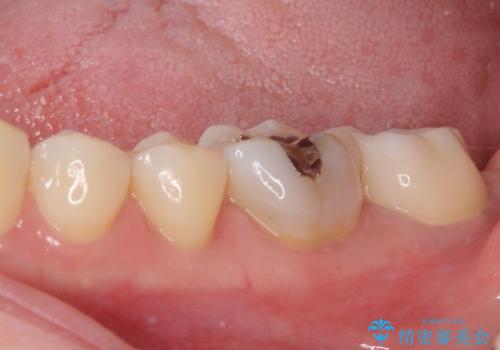 奥歯が痛い　保険治療後に症状が発現した歯のむし歯治療の治療後