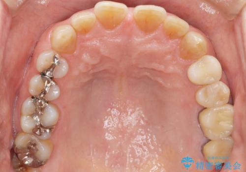 歯ぐきから出る膿　何度治療しても治らない　精密根管治療　50代男性の治療後