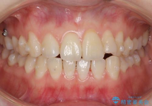 前歯が気になる 大人のマウスピース矯正 矮小歯を整えるの治療中