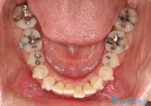 前歯のガタガタをインビザラインで矯正の治療中