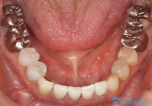 被せ物を入れたばかりの歯が痛む 40代女性の治療後