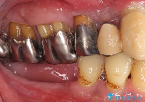 歯がぐらぐら　再生療法で抜かずに残す　50代男性の治療前
