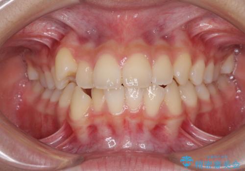 気がつくと口が開いてしまう　閉じにくい口元改善の抜歯矯正の症例 治療前