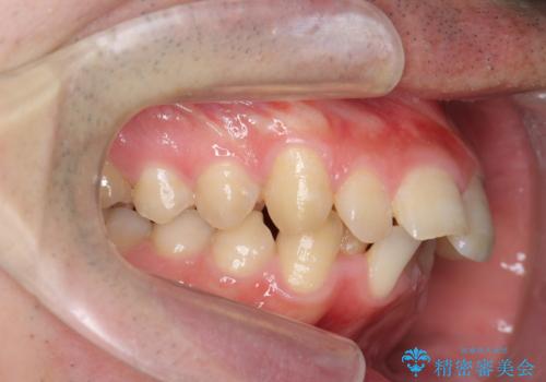 [ インビザライン ] マウスピース矯正で治す出っ歯の治療の治療前