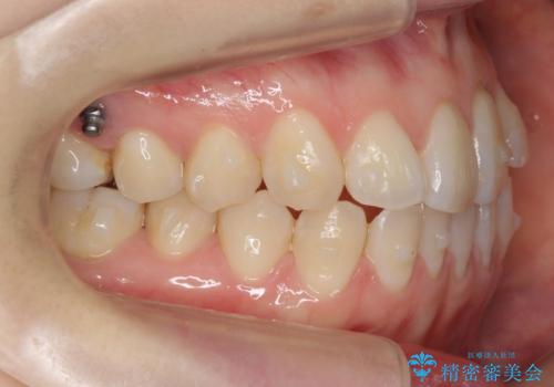 前歯が気になる　大人のマウスピース矯正　矮小歯を整えるの治療中
