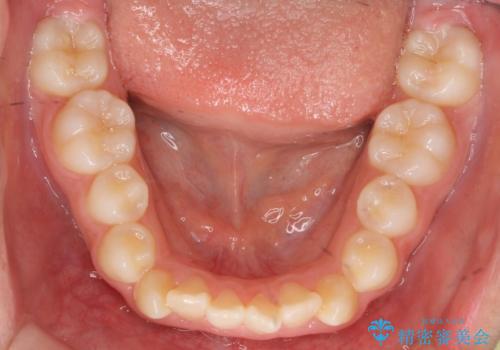 インビザラインチェンジで成功 インビザラインで八重歯の抜歯矯正の治療前