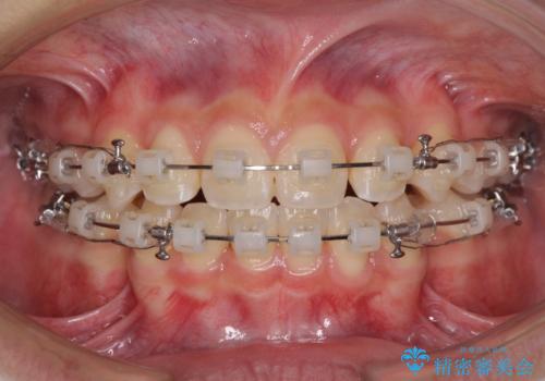 気がつくと口が開いてしまう 閉じにくい口元改善の抜歯矯正の治療中