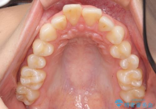 出っ歯　下の歯のガタガタ　下の前歯のみ1本抜歯　マウスピースで1年の治療中