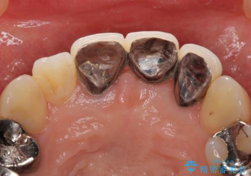 不自然なブリッジ 自然なセラミックでやりかえ 30代女性の治療前