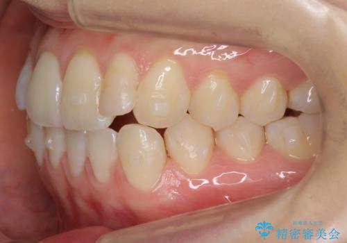 前歯が気になる 大人のマウスピース矯正 矮小歯を整えるの治療中