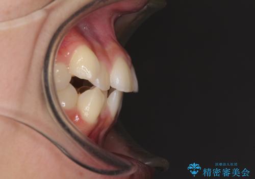 気がつくと口が開いてしまう 閉じにくい口元改善の抜歯矯正の治療前