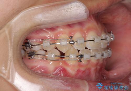 気がつくと口が開いてしまう 閉じにくい口元改善の抜歯矯正の治療中