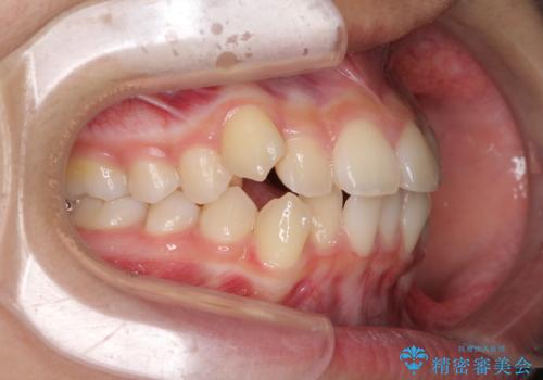 気がつくと口が開いてしまう 閉じにくい口元改善の抜歯矯正の治療前