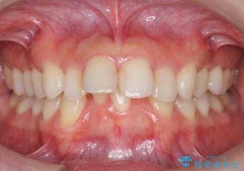 出っ歯　下の歯のガタガタ　下の前歯のみ1本抜歯　マウスピースで1年の症例 治療前