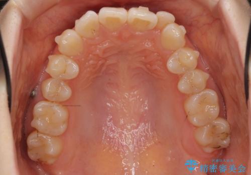 前歯が気になる　大人のマウスピース矯正　矮小歯を整えるの治療中