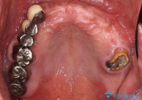 喫煙を再開してインプラント周囲炎に リカバリー治療 50代男性の治療前