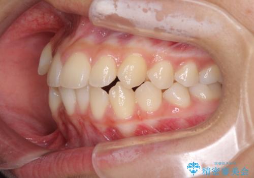 気がつくと口が開いてしまう 閉じにくい口元改善の抜歯矯正の治療前