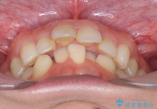 出っ歯　下の歯のガタガタ　下の前歯のみ1本抜歯　マウスピースで1年の治療前