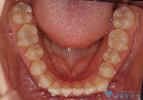 前歯が気になる 大人のマウスピース矯正 矮小歯を整えるの治療中