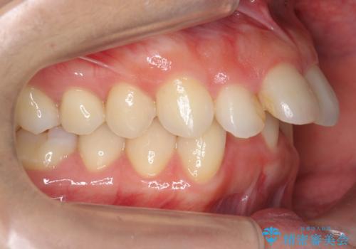 出っ歯　下の歯のガタガタ　下の前歯のみ1本抜歯　マウスピースで1年