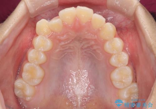 気がつくと口が開いてしまう 閉じにくい口元改善の抜歯矯正の治療前