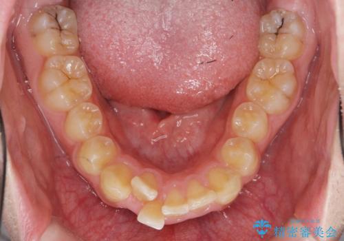 [ インビザライン ] マウスピース矯正で治す出っ歯の治療の治療前