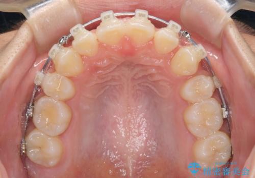 気がつくと口が開いてしまう 閉じにくい口元改善の抜歯矯正の治療中