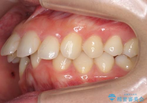 出っ歯 下の歯のガタガタ 下の前歯のみ1本抜歯 マウスピースで1年の治療前