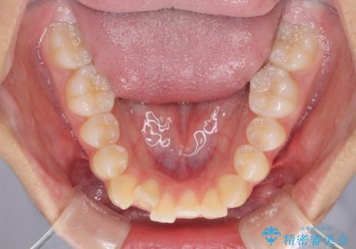 気がつくと口が開いてしまう 閉じにくい口元改善の抜歯矯正の治療前