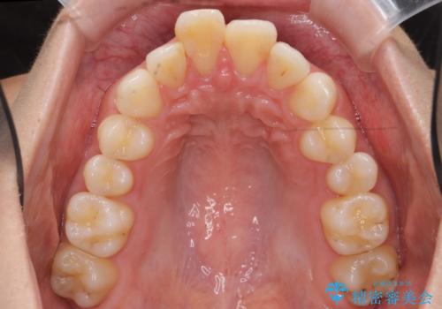 出っ歯 下の歯のガタガタ 下の前歯のみ1本抜歯 マウスピースで1年の治療前