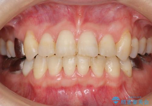 低予算で銀歯を白くしたい 50代女性の治療前