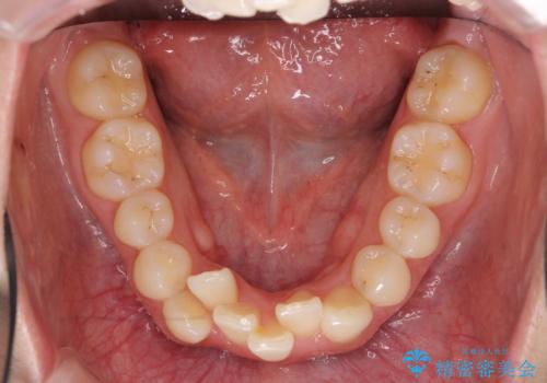 出っ歯　下の歯のガタガタ　下の前歯のみ1本抜歯　マウスピースで1年の治療前