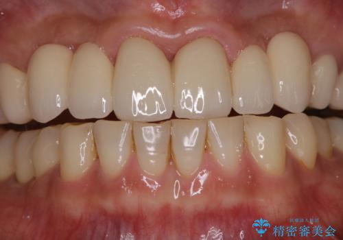 前歯のセラミックのチェックも合わせてPMTCでメンテナンスの症例 治療前