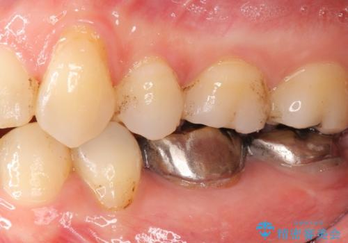 低予算で銀歯を白くしたい 50代女性の治療前