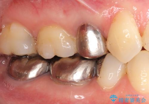 低予算で銀歯を白くしたい 50代女性の症例 治療前
