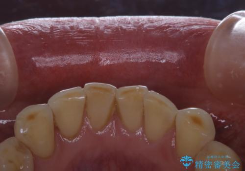 前歯のセラミックのチェックも合わせてPMTCでメンテナンスの治療前