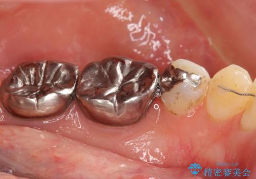 低予算で銀歯を白くしたい 50代女性の治療前