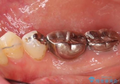 低予算で銀歯を白くしたい 50代女性の治療前