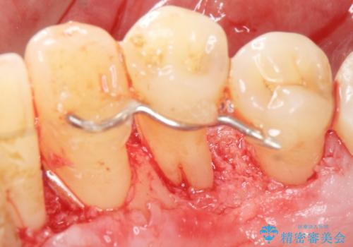 歯がぐらぐら 再生療法で抜かずに残す 50代男性の症例 治療後