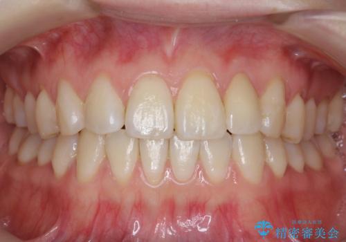 前歯が気になる　大人のマウスピース矯正　矮小歯を整えるの症例 治療後
