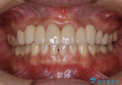 前歯のセラミックのチェックも合わせてPMTCでメンテナンス