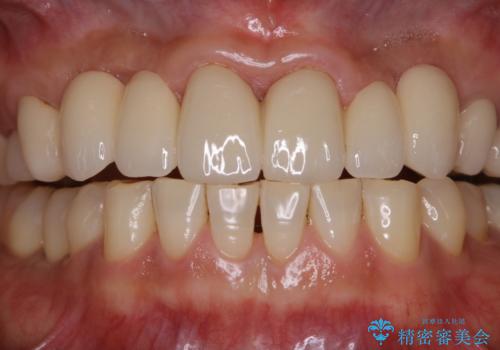 前歯のセラミックのチェックも合わせてPMTCでメンテナンスの症例 治療後