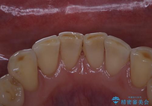 前歯のセラミックのチェックも合わせてPMTCでメンテナンスの治療後