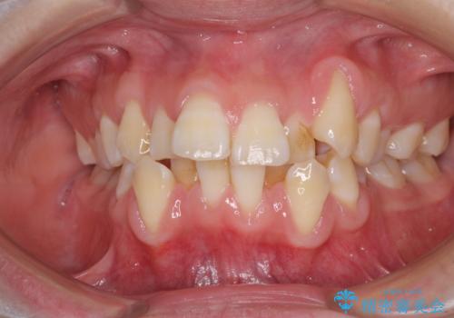 前歯が磨きにくい　目立たないワイヤー装置による矯正治療の症例 治療前