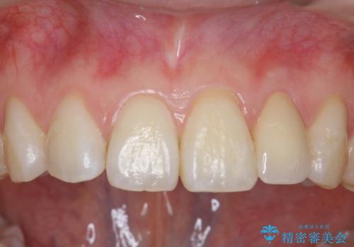 小さい前歯を整える　セラミック矯正の症例 治療後