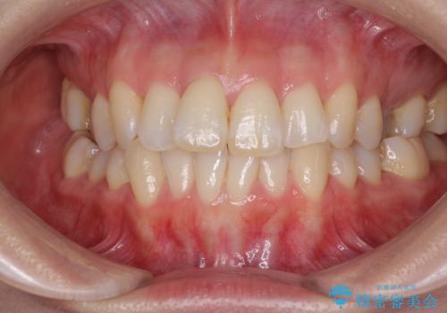 急速拡大装置で奥歯の咬み合わせを改善　インビザラインによる矯正治療の症例 治療前