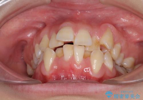 前歯が磨きにくい　目立たないワイヤー装置による矯正治療の治療前