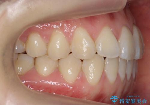 前歯が気になる　大人のマウスピース矯正　矮小歯を整えるの治療後